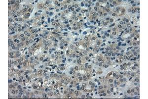 Immunohistochemical staining of paraffin-embedded Carcinoma of thyroid tissue using anti-CRYABmouse monoclonal antibody. (CRYAB antibody)