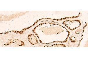 Immunohistochemistry of paraffin-embedded Human thyroid cancer tissue using METTL1 Polyclonal Antibody at dilution of 1:50(x200) (METTL1 antibody)