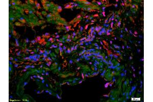 Formalin-fixed and paraffin-embedded human colon carcinoma labeled with Anti-VE Cadherin/VECD/CD144 Polyclonal Antibody, Unconjugated (ABIN1387250) 1:200, overnight at 4°C, The secondary antibody was Goat Anti-Rabbit IgG, Cy3 conjugated used at 1:200 dilution for 40 minutes at 37°C. (Cadherin 5 antibody  (AA 251-320))