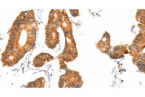 Immunohistochemistry of paraffin-embedded Human colon cancer tissue using ACOX1 Polyclonal Antibody at dilution 1:40 (ACOX1 antibody)