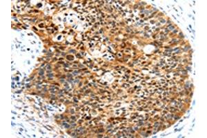 The image on the left is immunohistochemistry of paraffin-embedded Human esophagus cancer tissue using ABIN7191028(HUNK Antibody) at dilution 1/35, on the right is treated with synthetic peptide. (HUNK antibody)