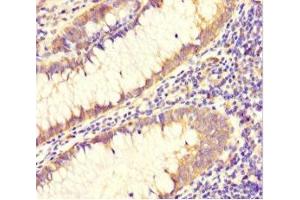 Immunohistochemistry of paraffin-embedded human colon cancer using ABIN7150029 at dilution of 1:100 (DAAM2 antibody  (AA 1-101))