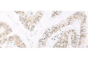 Immunohistochemistry of paraffin-embedded Human liver cancer tissue using HABP4 Polyclonal Antibody at dilution of 1:60(x200)