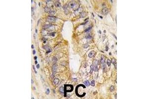 Formalin-fixed and paraffin-embedded human prostata carcinoma tissue reacted with PDGFRA Antibody , which was peroxidase-conjugated to the secondary antibody, followed by DAB staining. (PDGFRA antibody  (AA 746-775))