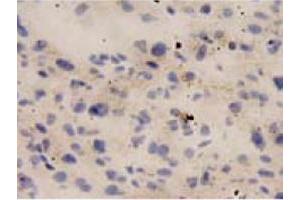 Immunohistochemical staining of human liver cancer tissue section with IL18 monoclonal antibody, clone 2  at 1:10 dilution.