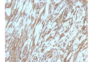Formalin-fixed, paraffin-embedded human Leiomyosarcoma stained with Muscle Specific Actin Mouse Monoclonal Antibody (MSA/953).