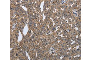 Immunohistochemistry of Human lung cancer using PDIA2 Polyclonal Antibody at dilution of 1:50 (PDIA2 antibody)