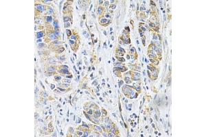 Immunohistochemistry of paraffin-embedded human liver cancer using VAPB Antibody (ABIN5973099) at dilution of 1/200 (40x lens). (VAPB antibody)