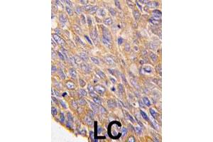Formalin-fixed and paraffin-embedded human lung carcinoma tissue reacted with TOB2 polyclonal antibody  , which was peroxidase-conjugated to the secondary antibody, followed by DAB staining. (TOB2 antibody  (N-Term))