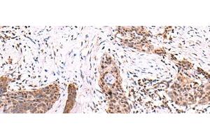Immunohistochemistry of paraffin-embedded Human esophagus cancer tissue using SCCPDH Polyclonal Antibody at dilution of 1:85(x200) (SCCPDH antibody)