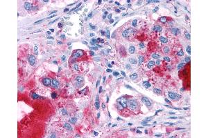 Anti-GPR82 antibody IHC of human Lung, Adenocarcinoma. (GPR82 antibody  (Cytoplasmic Domain))