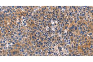 Immunohistochemistry of paraffin-embedded Human liver cancer tissue using ARRB1 Polyclonal Antibody at dilution 1:50 (beta Arrestin 1 antibody)
