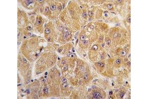IHC analysis of FFPE human hepatocarcinoma tissue stained with ALDH1A1 antibody (ALDH1A1 antibody  (AA 302-331))