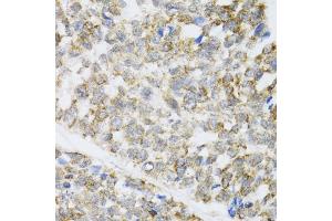 Immunohistochemistry of paraffin-embedded human esophageal cancer using ZAK antibody (ABIN6133445, ABIN6150360, ABIN6150361 and ABIN6223229) at dilution of 1:100 (40x lens). (ZAK antibody  (AA 1-330))