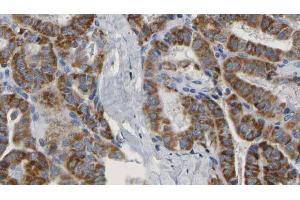 ABIN6267160 at 1/100 staining Human thyroid cancer tissue by IHC-P. (PRAS40 antibody  (pSer183))