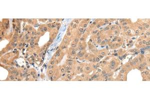Immunohistochemistry of paraffin-embedded Human thyroid cancer tissue using CA7 Polyclonal Antibody at dilution of 1:50(x200) (CA7 antibody)