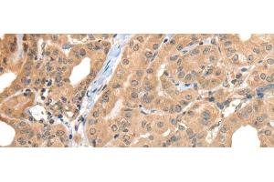 Immunohistochemistry of paraffin-embedded Human thyroid cancer tissue using CA7 Polyclonal Antibody at dilution of 1:50(x200)