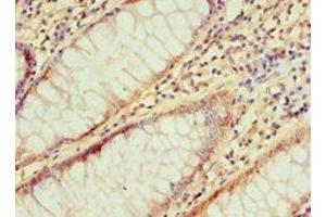 Immunohistochemistry of paraffin-embedded human colon cancer using ABIN7156754 at dilution of 1:100 (IRAK2 antibody  (AA 1-270))