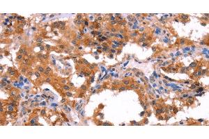 Immunohistochemistry of paraffin-embedded Human thyroid cancer using ERAS Polyclonal Antibody at dilution of 1:40 (ERAS antibody)