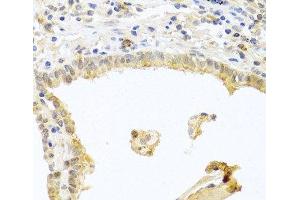 Immunohistochemistry of paraffin-embedded Human lung cancer using PRKCA Polyclonal Antibody at dilution of 1:100 (40x lens). (PKC alpha antibody)