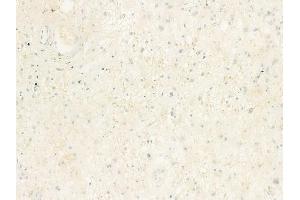 ABIN6263421 and ABIN6273057 at 1/100 staining human astrocytoma by IHC-P.