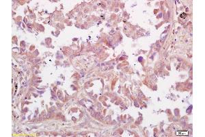 Formalin-fixed and paraffin embedded human lung carcinoma labeled with Rabbit Anti RSV Polyclonal Antibody, Unconjugated (ABIN674109) at 1:200 followed by conjugation to the secondary antibody and DAB staining (RSV antibody  (AA 151-250))