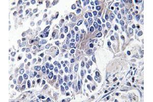 Immunohistochemical analysis of paraffin-embedded human lung cancer tissue using MAPK8IP3 polyclonal antibody . (JIP3 antibody)