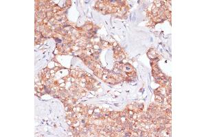 Immunohistochemistry of paraffin-embedded human breast cancer using TIMM8B antibody (ABIN7270928) at dilution of 1:100 (40x lens). (TIMM8B antibody  (AA 16-98))