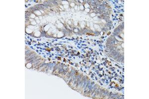 Immunohistochemistry of paraffin-embedded human colon carcinoma using STING antibody (ABIN7270958) at dilution of 1:25 (40x lens). (STING/TMEM173 antibody)