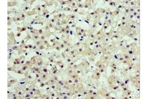 Immunohistochemistry of paraffin-embedded human liver cancer using ABIN7143462 at dilution of 1:100 (ARFGAP3 antibody  (AA 217-516))