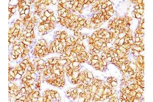 Image no. 1 for anti-Proximal-Nephrogenic Antigen / Renal Cell Carcinoma (RCC) antibody (ABIN6153794) (Proximal-Nephrogenic Antigen / Renal Cell Carcinoma (RCC) antibody)