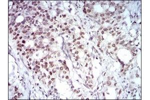 Immunohistochemical analysis of paraffin-embedded human cervical cancer tissues using MAPK7 mouse mAb with DAB staining. (MAPK7 antibody  (AA 411-556))
