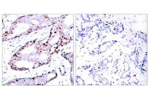 Immunohistochemical analysis of paraffin- embedded human breast carcinoma tissue using c-Jun (Ab-73) antibody (E021003). (C-JUN antibody)