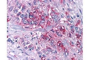 Anti-P2RY4 / P2Y4 antibody IHC of human Pancreas, Carcinoma. (P2RY4 antibody  (Cytoplasmic Domain))