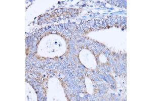 Immunohistochemistry of paraffin-embedded human colon carcinoma using MT-ND3 antibody (ABIN7268601) at dilution of 1:100 (40x lens). (MT-ND3 antibody)