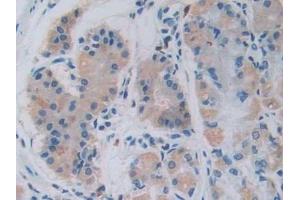 Detection of GHRH in Human Stomach cancer Tissue using Monoclonal Antibody to Growth Hormone Releasing Hormone (GHRH) (GHRH antibody  (AA 19-108))