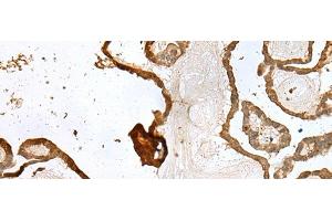 Immunohistochemistry of paraffin-embedded Human thyroid cancer tissue using UBE2Z Polyclonal Antibody at dilution of 1:35(x200) (UBE2Z antibody)