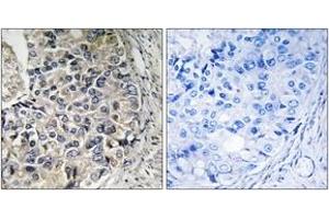 Immunohistochemistry analysis of paraffin-embedded human prostate carcinoma tissue, using CMC1 Antibody. (CMC1 antibody  (AA 391-440))