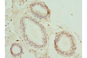 Immunohistochemistry of paraffin-embedded human breast cancer using ABIN7159178 at dilution of 1:100 (MATK antibody  (AA 393-507))