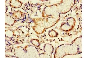 Immunohistochemistry of paraffin-embedded human gastric cancer using ABIN7145670 at dilution of 1:100 (C6orf89 antibody  (AA 120-320))