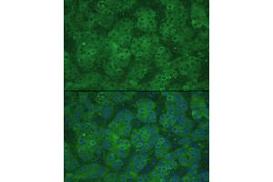 Immunofluorescence analysis of human liver cancer using CBS Rabbit pAb (ABIN3021958, ABIN3021959, ABIN3021960 and ABIN6218521) at dilution of 1:100 (40x lens).