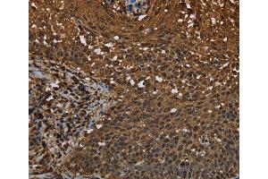 Immunohistochemistry of Human colon cancer using MYBBP1A Polyclonal Antibody at dilution of 1:40 (MYBBP1A antibody)
