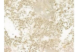 ABIN6265500 and ABIN6276544 at 1/100 staining human breast carcinoma by IHC-P. (TCF4 antibody  (N-Term))