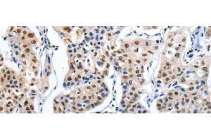 Immunohistochemistry of paraffin-embedded Human lung cancer tissue using MAGEA6 Polyclonal Antibody at dilution 1:120 (MAGEA6 antibody)