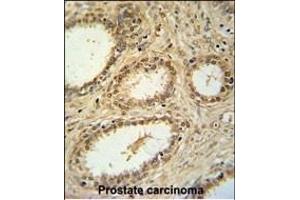 SNRNP40 Antibody (Center) (ABIN651465 and ABIN2840256) immunohistochemistry analysis in formalin fixed and paraffin embedded human prostate carcinoma followed by peroxidase conjugation of the secondary antibody and DAB staining. (SNRNP40 antibody  (AA 122-149))