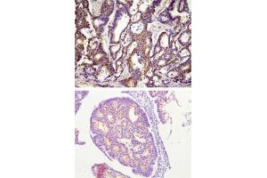 Paraffin embedded sections of human colon cancer tissue were incubated with ACOT11 monoclonal antibody, clone J4B2  (1:100) for 2 hours at room temperature.