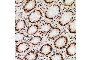 Immunohistochemical analysis of ZNF839 staining in human colon cancer formalin fixed paraffin embedded tissue section.