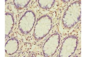 Immunohistochemistry of paraffin-embedded human colon cancer using ABIN7153651 at dilution of 1:100 (Gasdermin B antibody  (AA 63-310))
