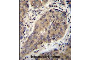 WTIP Antibody immunohistochemistry analysis in formalin fixed and paraffin embedded human hepatocarcinoma followed by peroxidase conjugation of the secondary antibody and DAB staining.