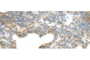 Immunohistochemistry of paraffin-embedded Human thyroid cancer using SERPINB11 Polyclonal Antibody at dilution of 1/20 (SERPINB11 antibody)
